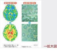 脳内の血流量とサラサラ状態の変化